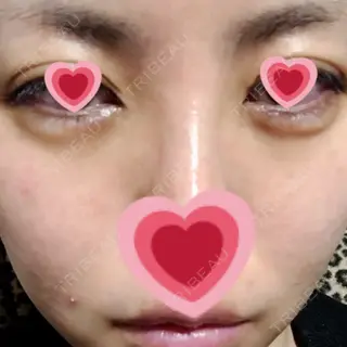 7日目の経過画像（1枚目）