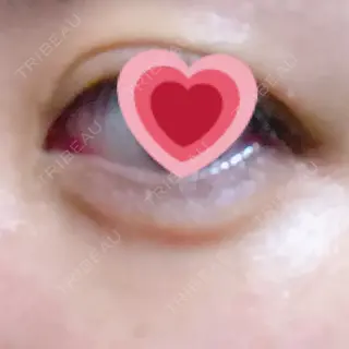 8日目の経過画像（3枚目）