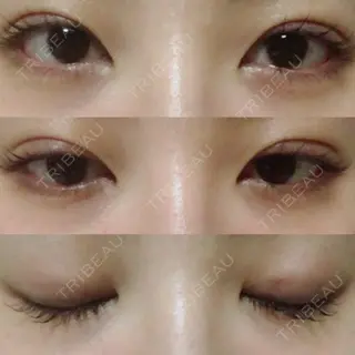 13日目の経過画像（1枚目）