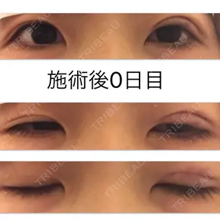 0日目の経過画像（1枚目）