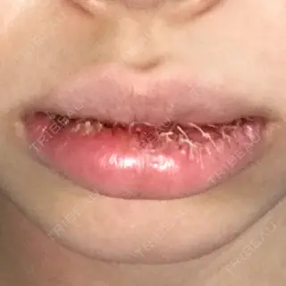 1日目の経過画像（2枚目）