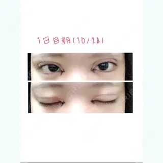 1日目の経過画像（1枚目）