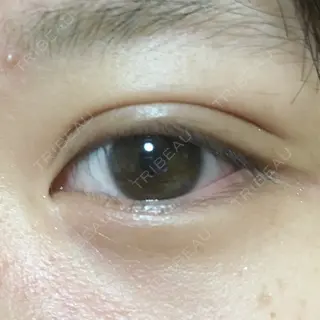 14日目の経過画像（2枚目）