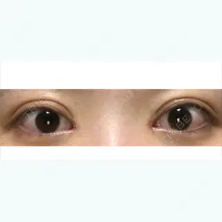 15日目の経過画像（1枚目）