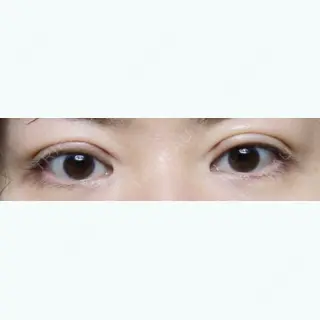 34日目の経過画像（1枚目）
