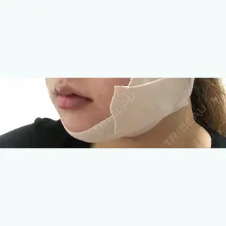 0日目の経過画像（2枚目）