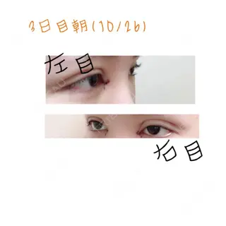 3日目の経過画像（2枚目）