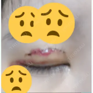 4日目の経過画像（2枚目）