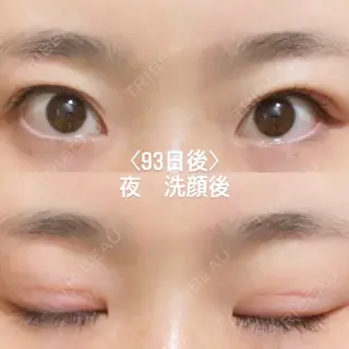 93日目の経過画像（1枚目）