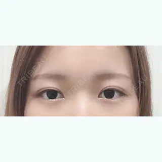 185日目の経過画像（1枚目）