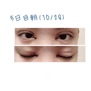 5日目の経過画像（1枚目）
