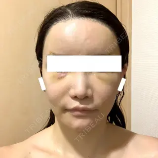 3日目の経過画像（1枚目）