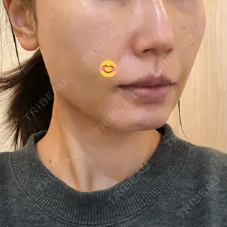 4日目の経過画像（2枚目）