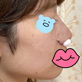 0日目の経過画像（2枚目）