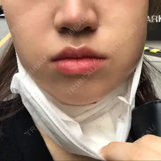 0日目の経過画像（2枚目）
