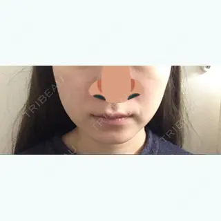 4日目の経過画像（1枚目）