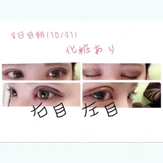 8日目の経過画像（3枚目）