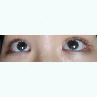 83日目の経過画像（1枚目）