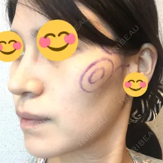 71日目の経過画像（1枚目）