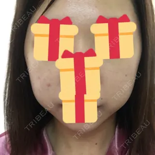 3日目の経過画像（2枚目）