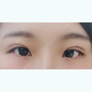 3日目の経過画像（1枚目）