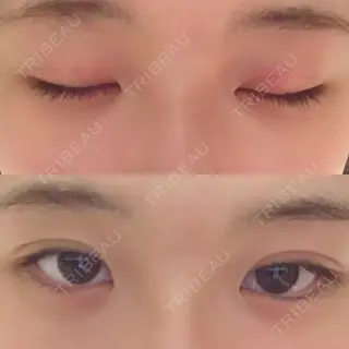 0日目の経過画像（1枚目）