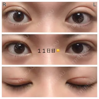 11日目の経過画像（1枚目）