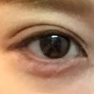 2日目の経過画像（1枚目）