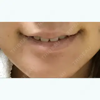 2日目の経過画像（3枚目）