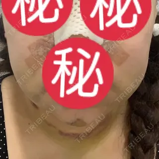 4日目の経過画像（1枚目）