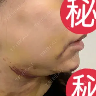 7日目の経過画像（2枚目）