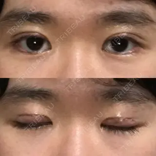 5日目の経過画像（1枚目）