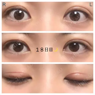 18日目の経過画像（1枚目）
