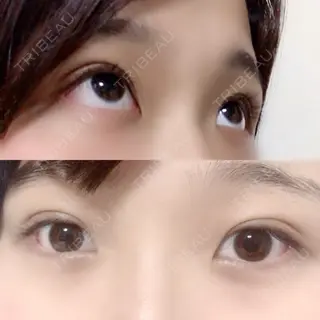 11日目の経過画像（3枚目）