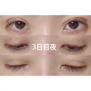 3日目の経過画像（1枚目）