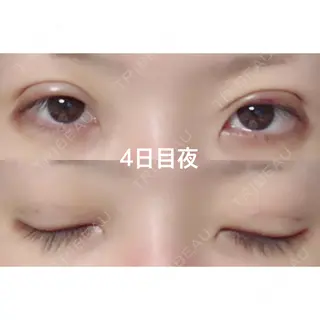 4日目の経過画像（1枚目）