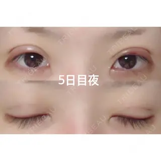 5日目の経過画像（1枚目）
