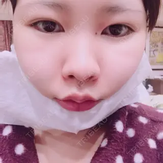 0日目の経過画像（3枚目）