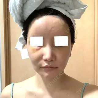 5日目の経過画像（2枚目）