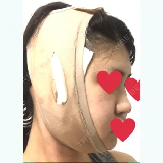4日目の経過画像（3枚目）