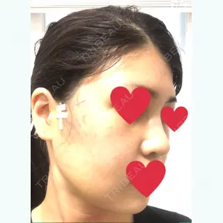 5日目の経過画像（2枚目）