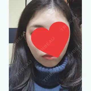 20日目の経過画像（1枚目）