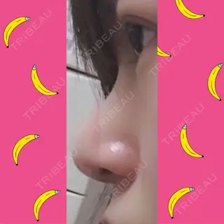 28日目の経過画像（2枚目）