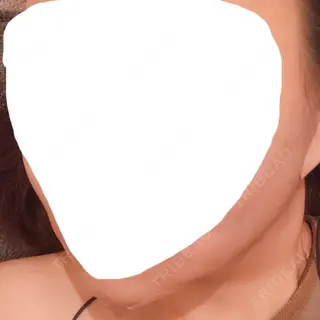 0日目の経過画像（2枚目）