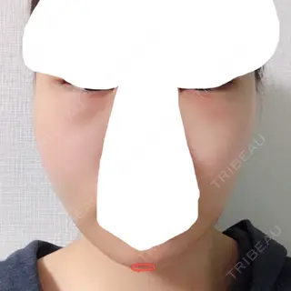 1日目の経過画像（1枚目）