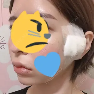 0日目の経過画像（2枚目）