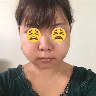 4日目の経過画像（1枚目）