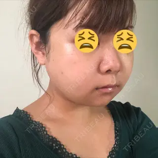 4日目の経過画像（2枚目）