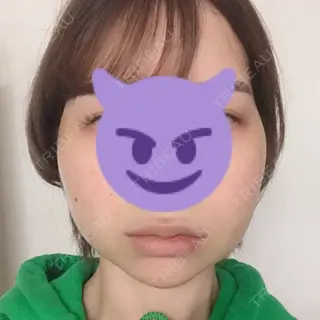 3日目の経過画像（1枚目）