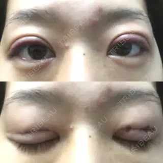 0日目の経過画像（1枚目）